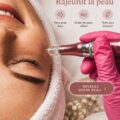 Microneedling en action, technique de soins de la peau pour rajeunir et revitaliser.